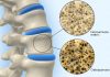 What is Osteoporosis and Why Do We Suffer It: As We Get Older, the Risk of Bone Loss and Related Fractures Grow osteoporosis bone turnover bone mass