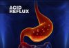 How to Relieve Acid Reflux Symptoms: Ways to Treat Symptoms of Acid Reflux
