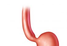 How to Treat a Hard Bloated Stomach