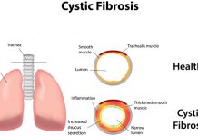 Cystic Fibrosis Postural Drainage: Introduction to Chest Physical Therapy