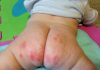 Preventing Diaper Rash: Keep Your Infant’s Skin Healthy air dry diaper rashes preventing diaper rash diaper rash frequent diaper changes