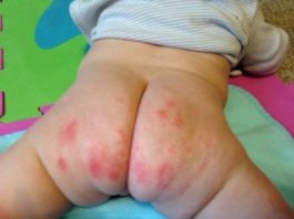 air dry diaper rashes preventing diaper rash diaper rash frequent diaper changes