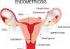 Causes of Endometriosis: Recent Study Discusses Findings women who have endometriosis