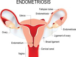 women who have endometriosis