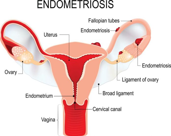 women who have endometriosis