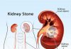 When Kidney Stones Strike: Recognising The Symptoms And Getting Treatment