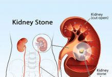 When Kidney Stones Strike: Recognising The Symptoms And Getting Treatment