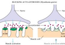 Myasthenia Gravis Treatment: Ways to Treat the Neuromuscular Disease Myasthenia Gravis myasthenia gravis