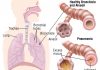 How is Pneumonia Diagnosed? Find Out How This Disease Is Sorted Out pneumonia patient how is pneumonia diagnosed diagnosis of pneumonia