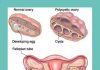 Polycystic Ovarian Syndrome (PCOS): Stubborn weight and missed periods are key symptoms. polycystic ovarian syndrome a disorder