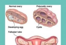 Polycystic Ovarian Syndrome (PCOS): Stubborn weight and missed periods are key symptoms. polycystic ovarian syndrome a disorder