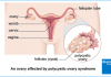 Polycystic Ovary Syndrome (PCOS): A Medical Condition Caused by Hormonal Imbalance polycystic ovary syndrome pcos